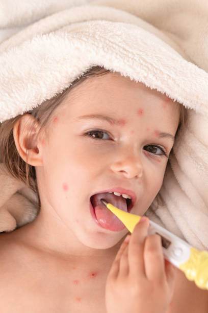 Child with chicken pox lying in bed with Thermometer stock photo