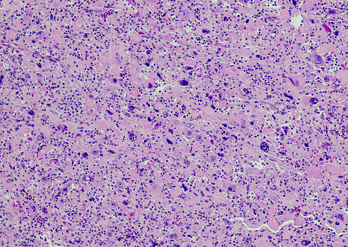 anaplastic thyroid carcinoma with heterologous differentiation (leiomyosarcoma)