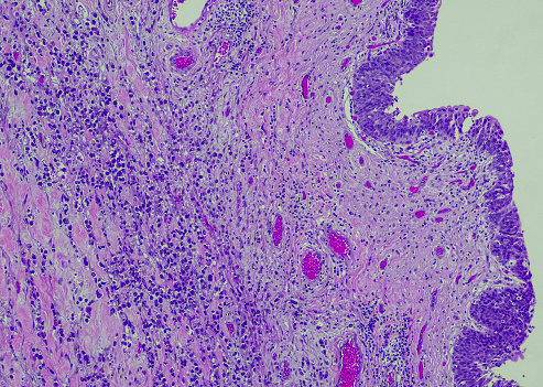 Plasmacytoid urothelial carcinoma (PUC) is a unique variant of invasive urothelial carcinoma characterized by tumor cells that exhibit a striking resemblance to plasma cells, and it is known to have an aggressive behavior.