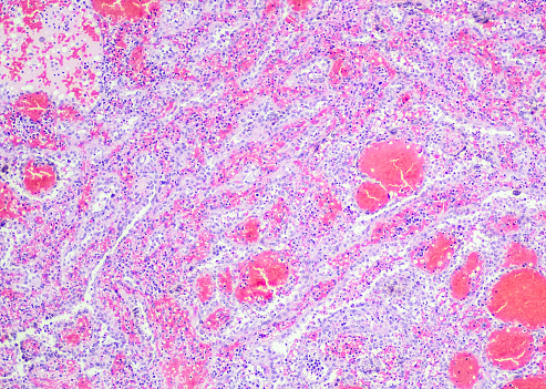 Littoral cell angioma