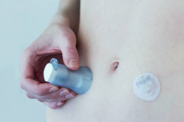 istock Woman placing an infusion set on her belly 1419065675