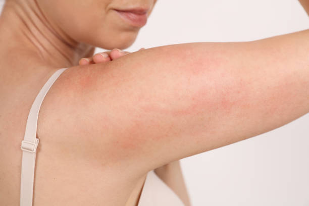 Skin redness and itching concept. Sensitive Skin, Food allergy symptoms, Irritation stock photo