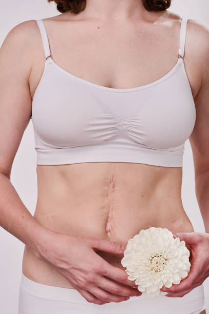 istock Female body with scar on her belly 1419251854