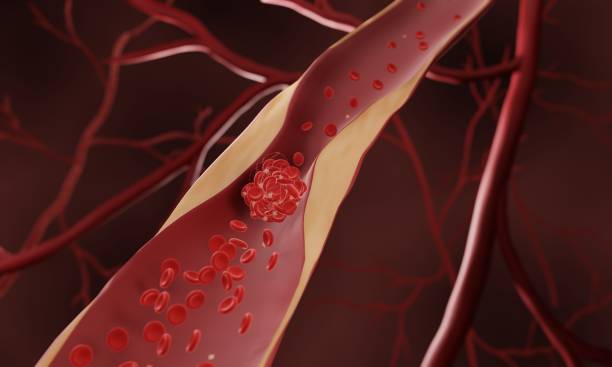 Atherosclerosis Atherosclerosis, Narrowed artery caused by cholesterol and fat accumulating in artery atherosclerosis stock pictures, royalty-free photos & images