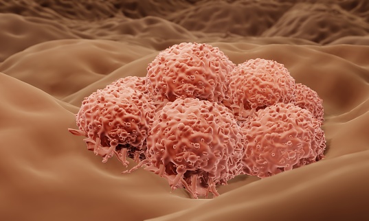 Skin tumor, Melanoma cells in human body
