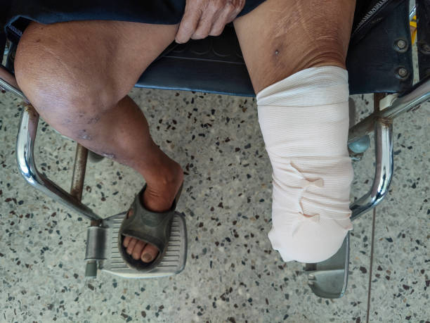 istock below knee amputation Patient with elastic bandaging to prepare for leg prosthesis 1419300184