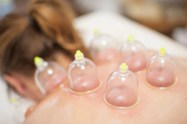 Glass vacuum cupping therapy on a woman's back, acupuncture treatment. Ventosa traditional massage. Alternative Medicine. Medical health care