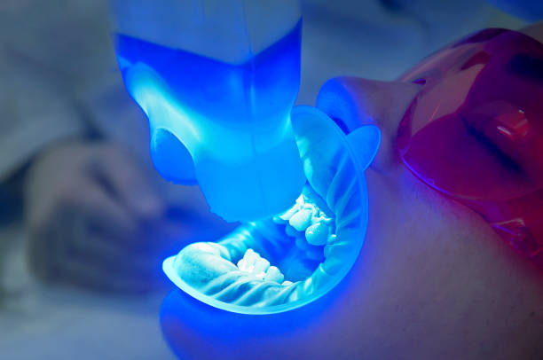 nahaufnahme eines mädchens beim zahnarzt mit uv-lichtbehandlung. zahnaufhellung - zahnaufhellung stock-fotos und bilder