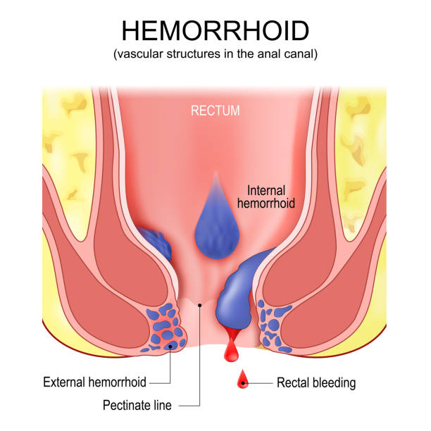 치질. 치 질의. 직장과 항문 운하의 횡단면 - hemorrhoid stock illustrations