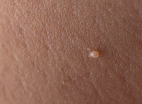 istock Papilloma virus in the human armpit,Human skin texture background 1419500284