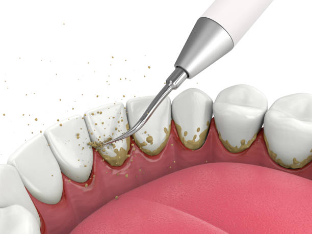 Descaling tartar and plaque from teeth by ultrasonic scaler stock photo