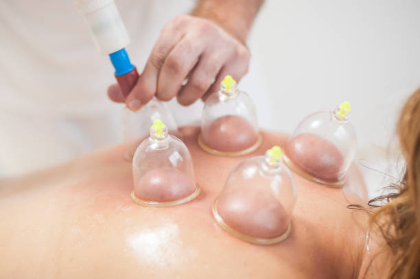 istock Multiple vacuum cup for medical cupping therapy on women's back 1419584436