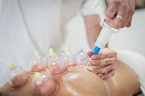 Asian chinese male patient receiving vacuum cupping therapy treatment at chinese medicine clinic