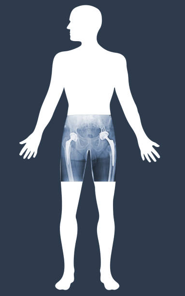 istock Viewing analytics at Hologram human anatomy and skeleton. X-ray both hip Total Hip Replacement.Medical image concept. 1419746206