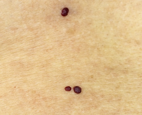Red moles on Caucasian skin, cherry angioma, senile angioma
