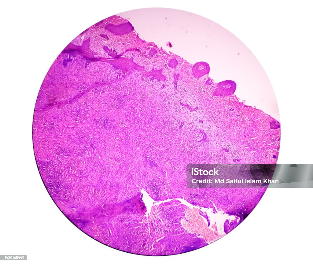 Skin biopsy : Suggestive of Basal cell carcinoma, the most common type of skin cancer. Basal Cell Carcinoma Stock Photo