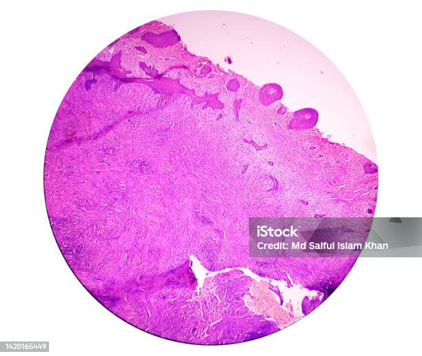 Skin Biopsy Suggestive Of Basal Cell Carcinoma The Most Common Type Of Skin Cancer Stock Photo - Download Image Now