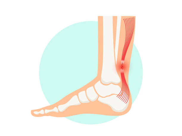 ilustrações de stock, clip art, desenhos animados e ícones de achilles tendon rupture anatomical poster. ankle injury, ligament sprain and tear problems - human muscle illustrations