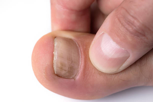 paznokieć z łuszczycą i zdrowe paznokcie u stóp, paznokieć łuszczycowa, zbliżenie. - podiatry chiropody toenail human foot zdjęcia i obrazy z banku zdjęć