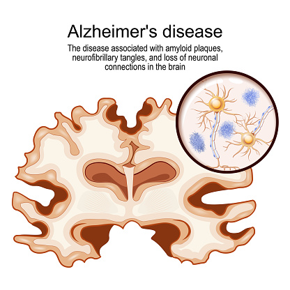Alzheimer's disease. disease associated with amyloid plaques, neurofibrillary tangles, and loss of neuronal connections in the brain. human brain with Alzheimer's disease. Close-up of neurons with amyloid plaques. Vector illustration