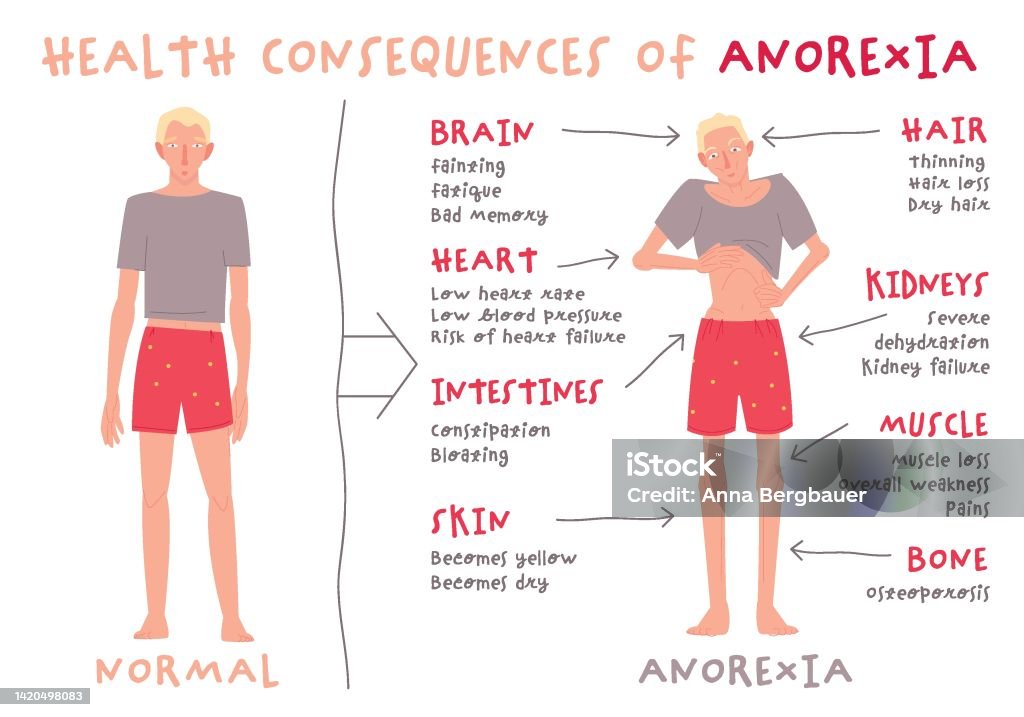 Eating Disorder In Men And Boys Anorexia Nervosa Stock Illustration Eating Disorder In Men And Boys Anorexia Nervosa Stock Illustration