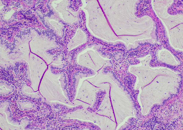 adenocarcinoma mucinoso invasivo - ovary human cell cell high scale magnification fotografías e imágenes de stock