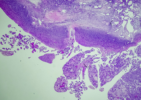 Well-differentiated papillary mesothelioma (WDPM) is an uncommon mesothelial tumor that occurs in the peritoneum of women over a wide age range. Although considered a tumor of uncertain malignant potential, information about its biological behavior is still limited.