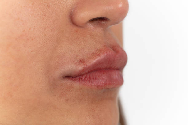 istock Close-up of female lips after augmentation. 1420550833