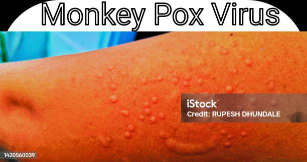 Pox Def Monkey Pox Virus Transmitted In Human Body Logo Stock Photo - Download ...