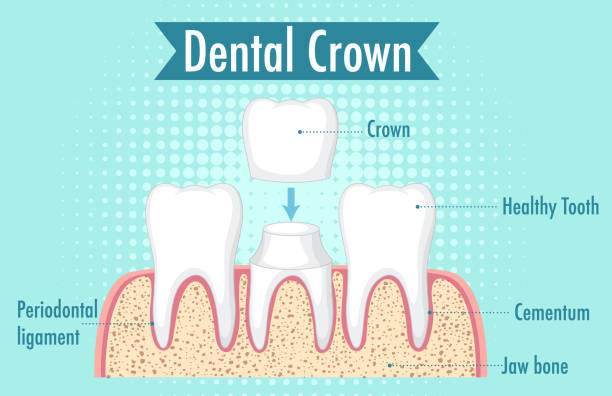 ilustrações de stock, clip art, desenhos animados e ícones de infographic of human in dental crown - boyhood