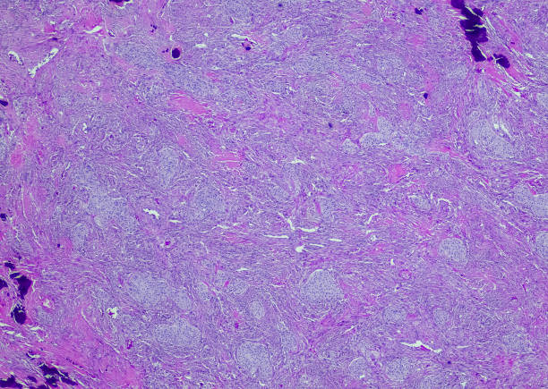 tumor benigno del brennero - ovary human cell cell high scale magnification fotografías e imágenes de stock