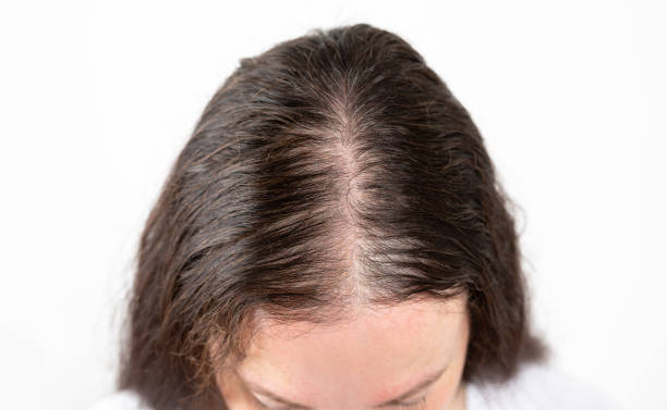 istock woman with alopecia 1420724342