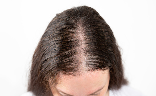 Hair loss concept. Head of woman on white background, closeup