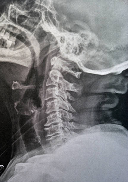 istock Plain X ray cervical vertebrae showing straightening of cervical vertebrae denoting muscle spasm and mild to moderate spondylosis from c3 3rd cervical vertebra to c6 6th cervical vertebra 1420736642