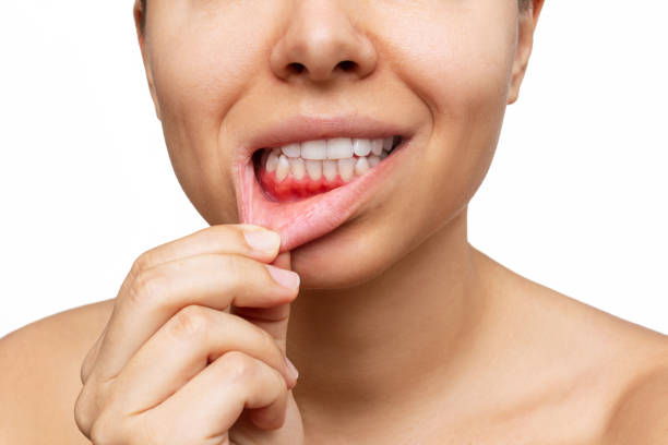 gum inflammation. cropped shot of a young woman shows red bleeding gums pulling the lip - dentist pain human teeth toothache imagens e fotografias de stock