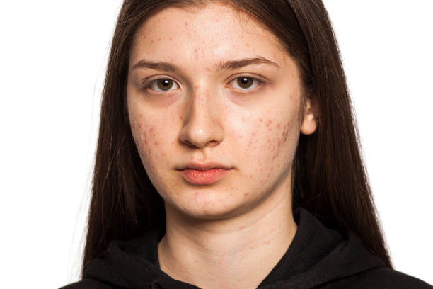 istock teenage girl with problematic skin on white background 1420931696
