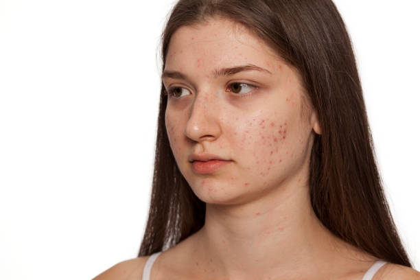 istock teenage girl with problematic skin on white background 1420931699