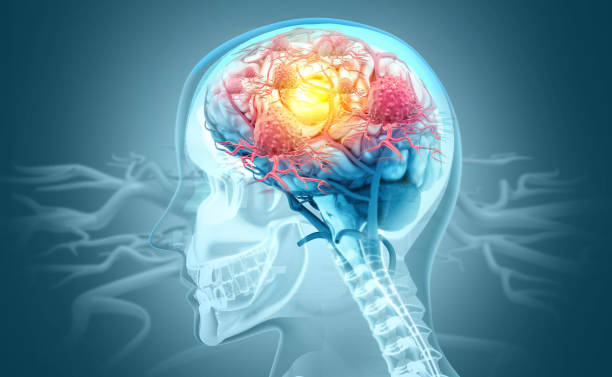 Cancer cells attacking a human brain. 3d illustration stock photo