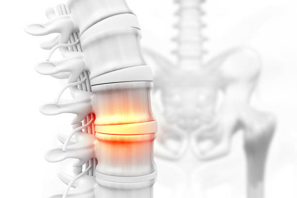поясничная межпозвоночная грыжа позвоночника. 3d иллюстрация - human skeleton body the human body pain стоковые фото и изображения
