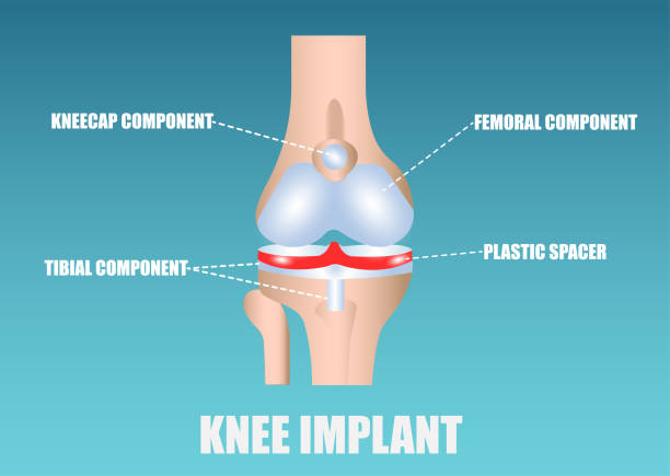 wektor implantu kolanowego - resurface stock illustrations