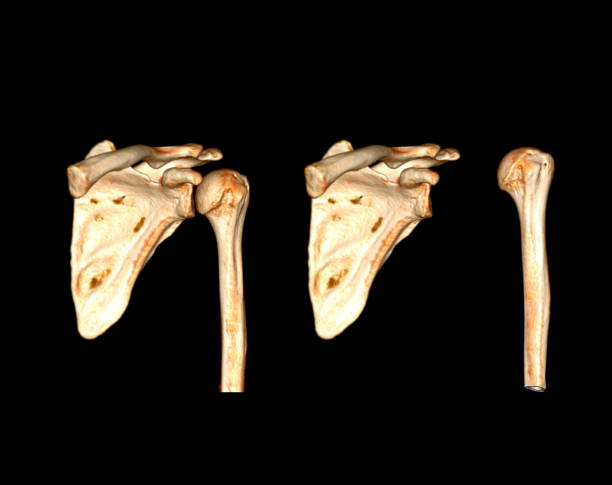istock CT scan of shoulder joint. 1421270198