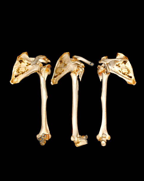 istock CT scan of shoulder joint and humerus bone or arm. 1421270305