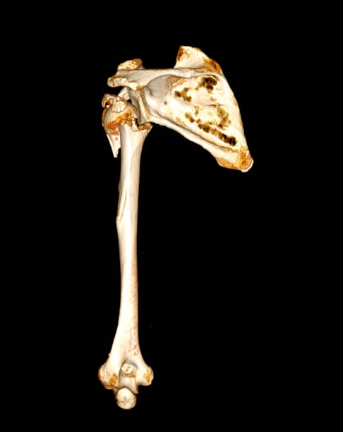 istock CT scan of shoulder joint and humerus bone or arm. 1421270583