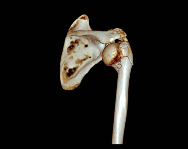 istock CT scan of shoulder joint. 1421270764