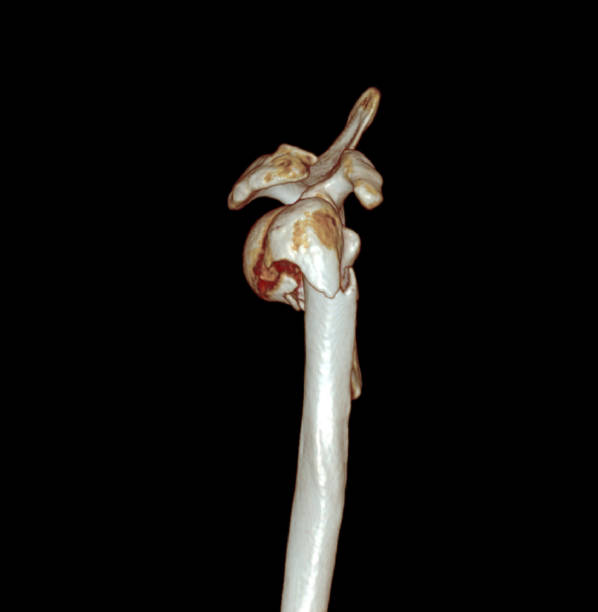istock CT scan of shoulder joint. 1421270952