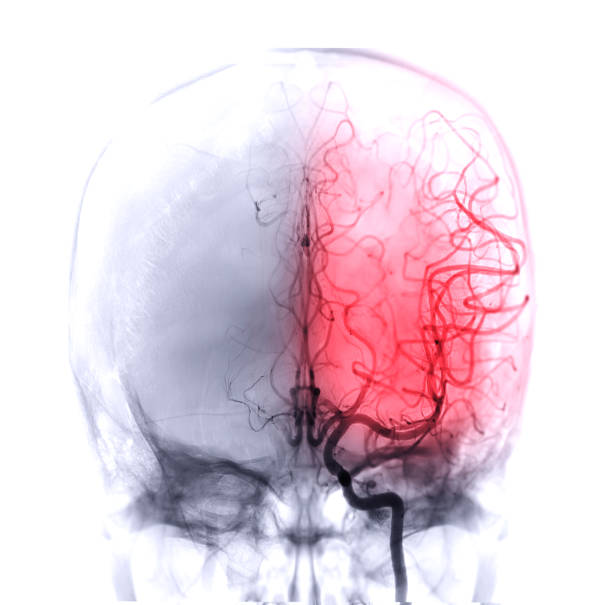 cerebrale angiographie - endhirn stock-fotos und bilder