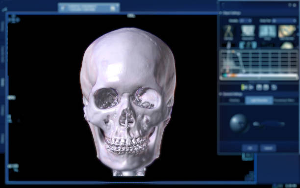 istock CT Scan of facial bone 3D rendering . 1421271312