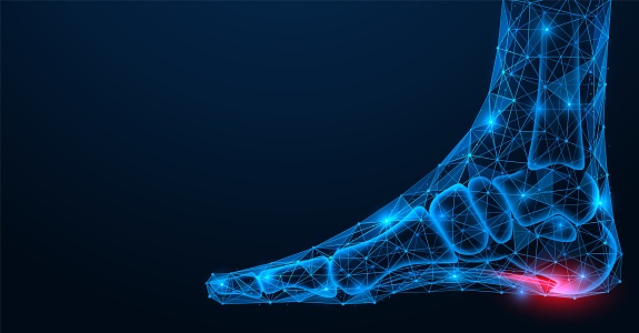 Heel spur, injury to the plantar ligament of the leg. Polygonal design of interconnected lines and points. Blue background.