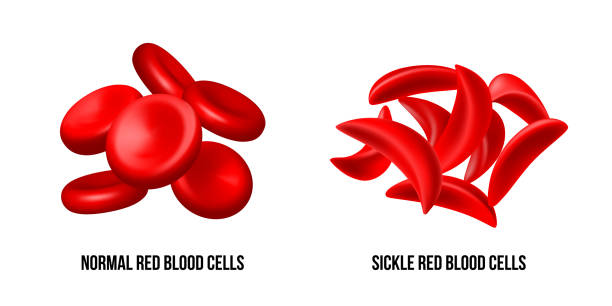 sichelzellenanämie. der unterschied von normalen roten blutkörperchen und sichelzellen. - sickle cell anemia red blood cell blood cell anemia stock-grafiken, -clipart, -cartoons und -symbole