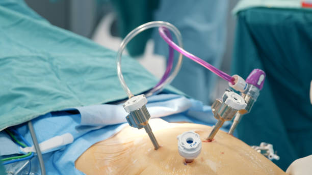 Laparoscopic surgery. Operation using laparoscopic equipment in hospital stock photo